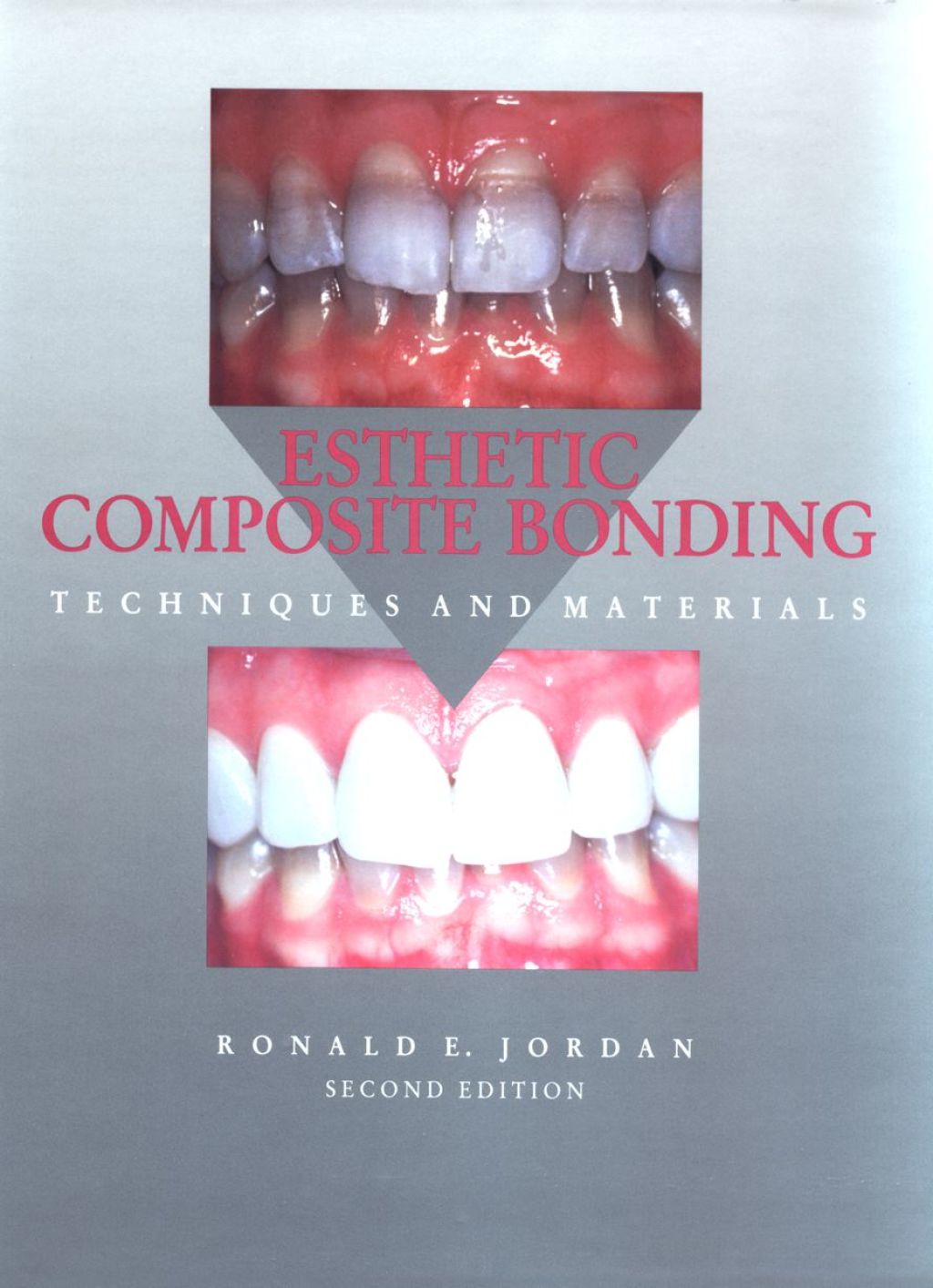 Reflowable Esthetic Composite Bonding; $129.87