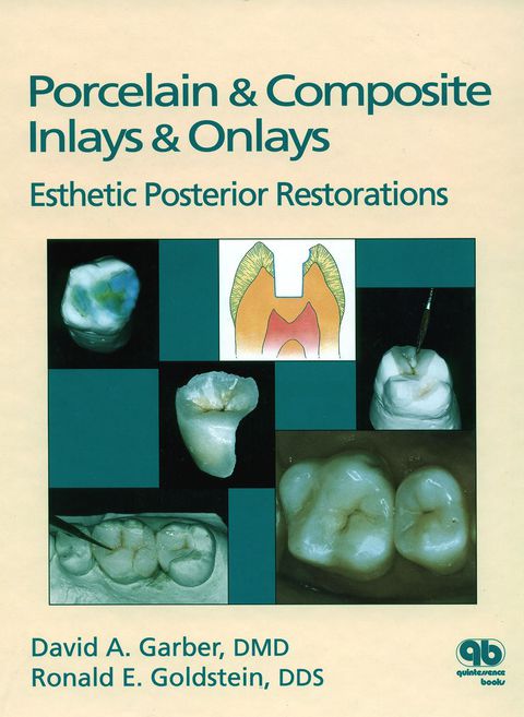 Cover image for book Porcelain & Composite Inlays & Onlays: Esthetic Posterior Restorations
