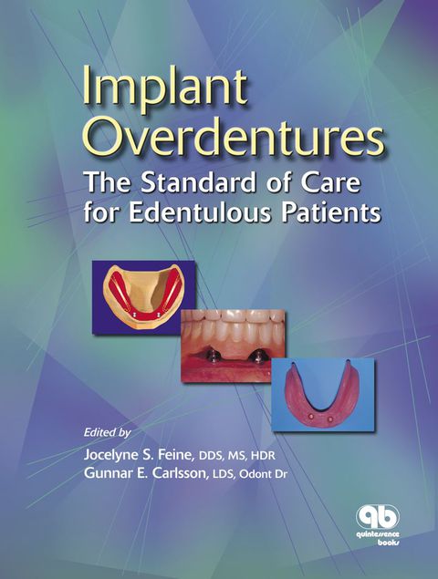 Cover image for book Implant Overdentures: The Standard of Care for Edentulous Patients