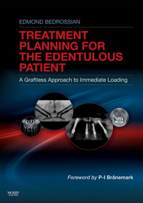 Cover image for book Implant Treatment Planning for the Edentulous Patient