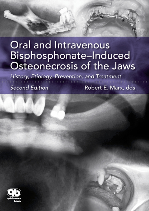 Cover image for book Oral and Intravenous Bisphosphonate–Induced Osteonecrosis of the Jaws: History, Etiology, Prevention, and Treatment