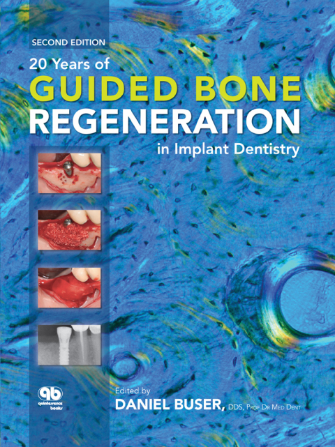 Cover image for book 20 Years of Guided Bone Regeneration in Implant Dentistry, Second Edition