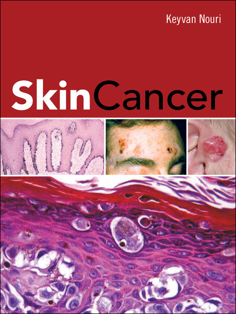Cover image for book Skin Cancer