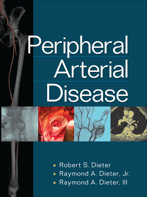 Cover image for book Peripheral Arterial Disease