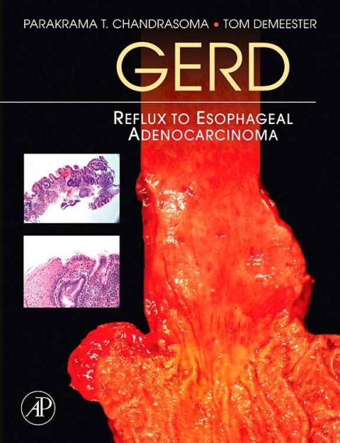 Cover image for book GERD: Reflux to Esophageal Adenocarcinoma