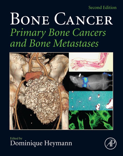 Cover image for book Bone Cancer: Primary Bone Cancers and Bone Metastases