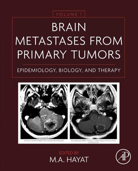 Cover image for book Brain Metastases from Primary Tumors: Epidemiology, Biology, and Therapy