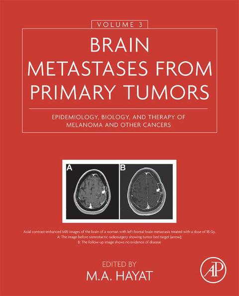 Cover image for book Brain Metastases from Primary Tumors, Volume 3: Epidemiology, Biology, and Therapy of Melanoma and Other Cancers