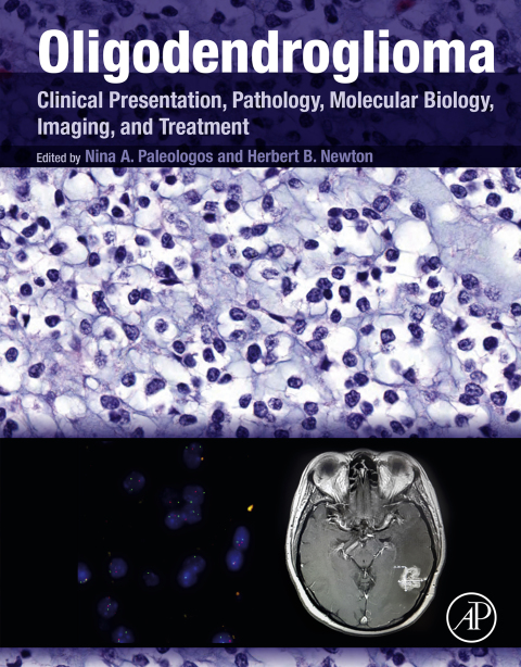 Cover image for book Oligodendroglioma