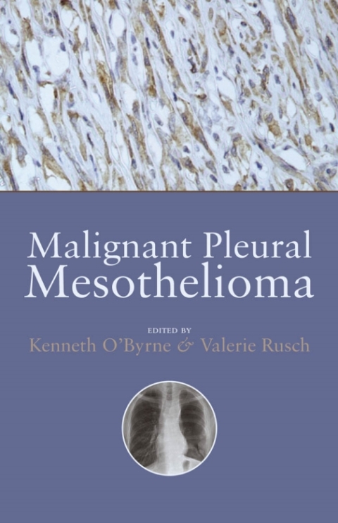 Cover image for book Malignant Pleural Mesothelioma