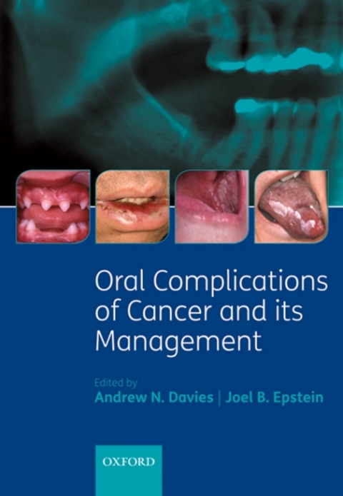 Cover image for book Oral Complications of Cancer and its Management