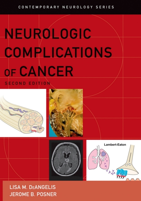 Cover image for book Neurologic Complications of Cancer