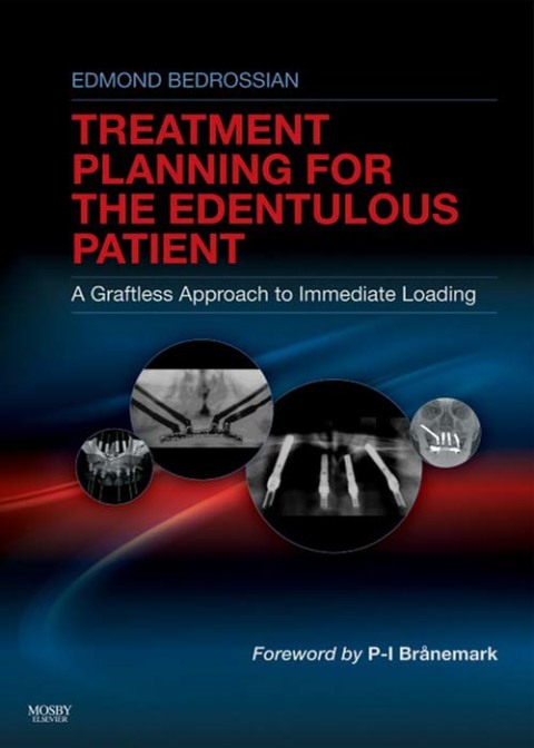 Cover image for book Implant Treatment Planning for the Edentulous Patient