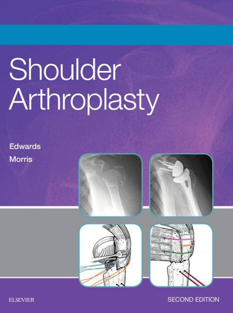 Cover image for book Shoulder Arthroplasty