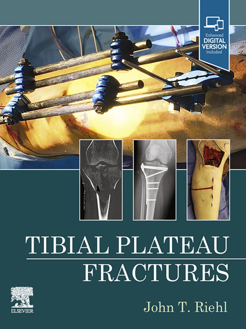 Cover image for book Tibial Plateau Fractures