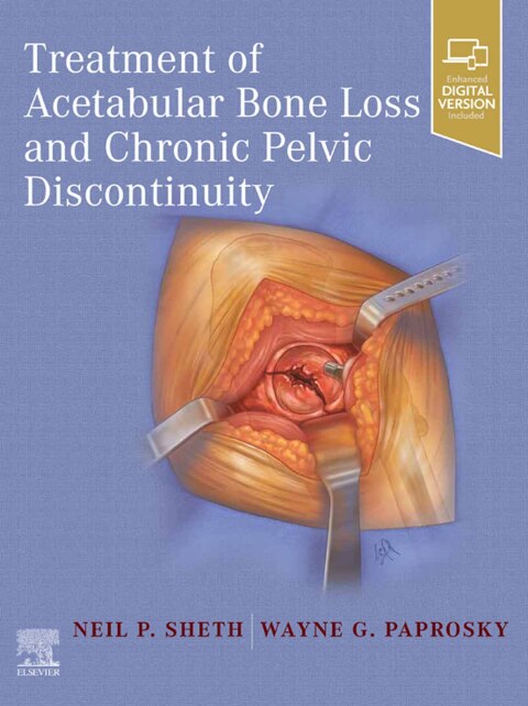 Cover image for book Treatment of Acetabular Bone Loss and Chronic Pelvic Discontinuity