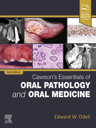 Cawson's Essentials of Oral Pathology and Oral Medicine