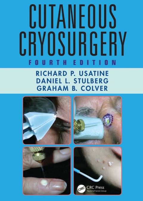 Cutaneous Cryosurgery 