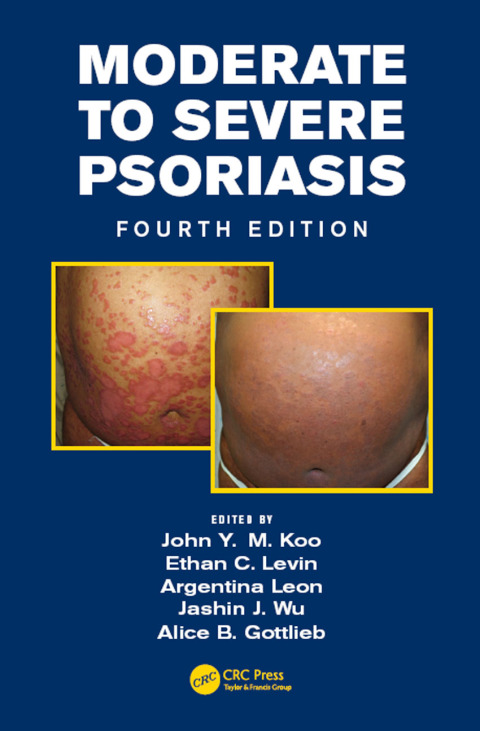 Cover image for book Moderate to Severe Psoriasis