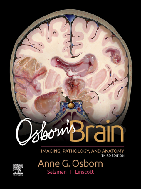 Osborn's Brain 