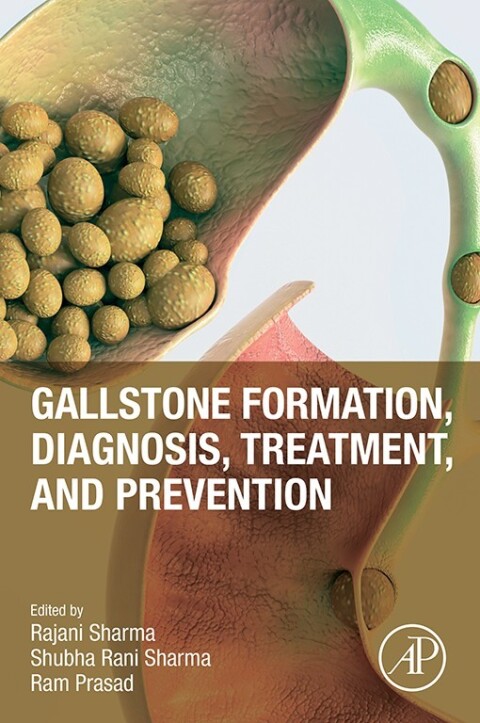 Gallstone Formation, Diagnosis, Treatment and Prevention 