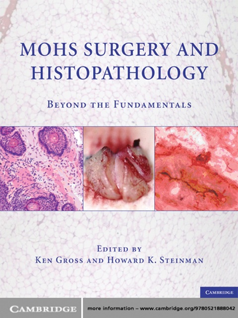 Mohs Surgery and Histopathology 