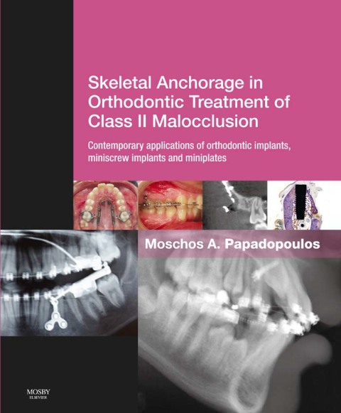 Cover image for book Skeletal Anchorage in Orthodontic Treatment of Class II Malocclusion