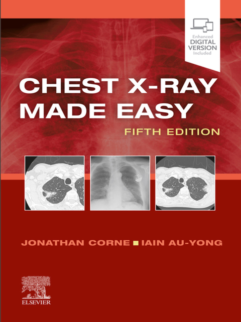Cover image for book Chest X-Ray Made Easy