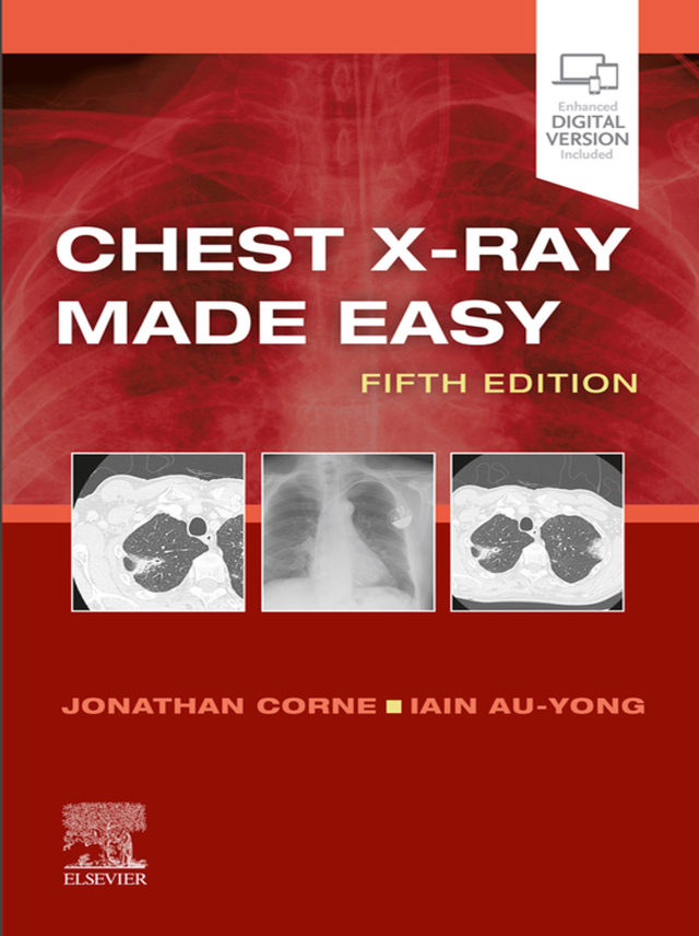Chest X Ray Made Easy