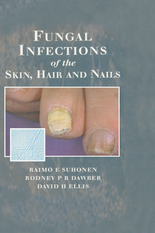 Fungal Infections of the Skin and Nails
