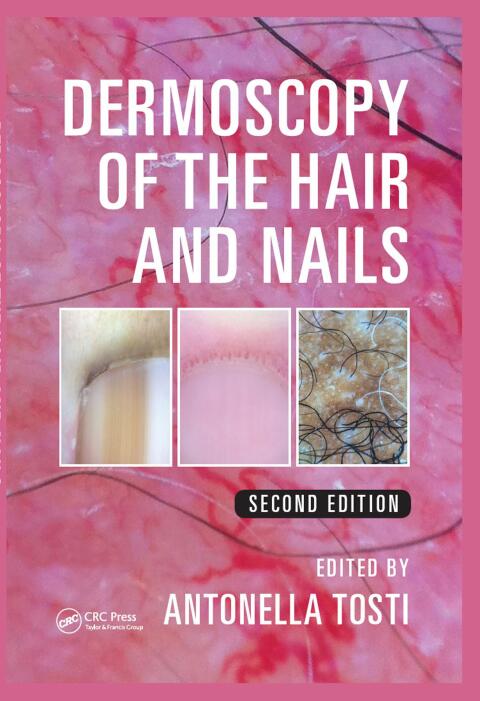 Dermoscopy of the Hair and Nails 