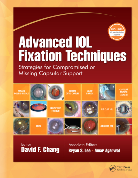Advanced IOL Fixation Techniques