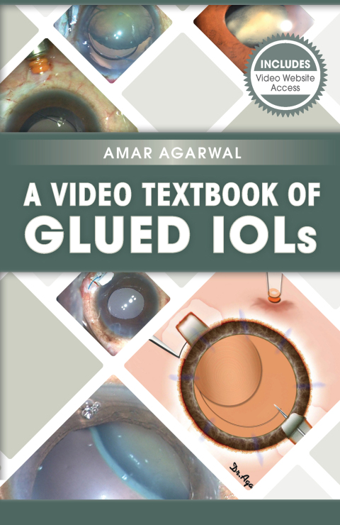 A Video Textbook of Glued IOLs 