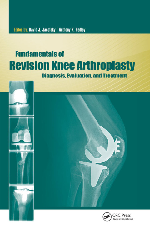 Fundamentals of Revision Knee Arthroplasty 