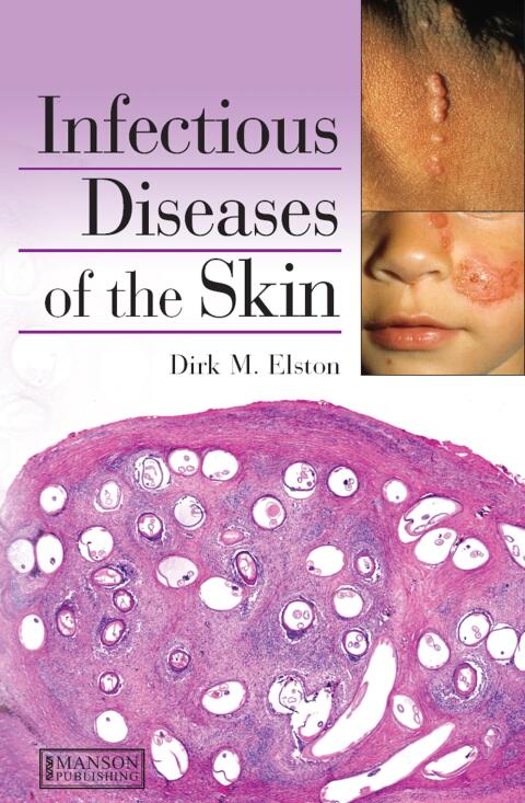 Infectious Diseases of the Skin 