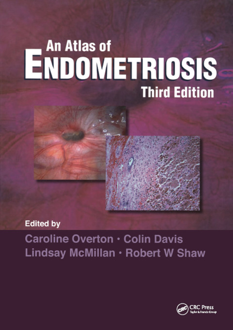 Atlas of Endometriosis 