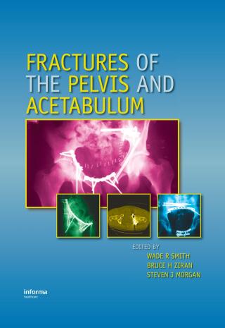 Fractures of the Pelvis and Acetabulum