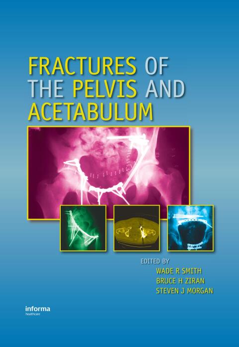 Cover image for book Fractures of the Pelvis and Acetabulum
