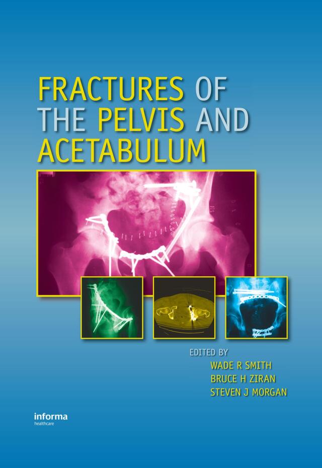 Fractures of the Pelvis and Acetabulum