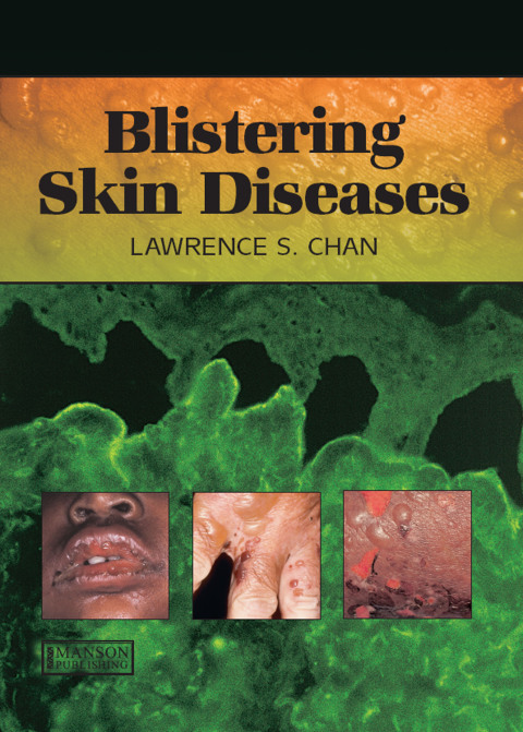 Cover image for book Blistering Skin Diseases