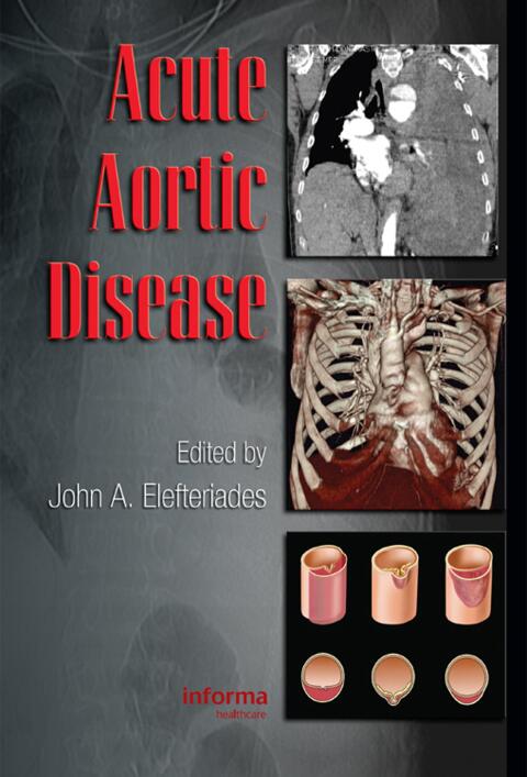 Cover image for book Acute Aortic Disease