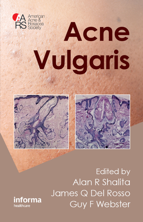 Cover image for book Acne Vulgaris