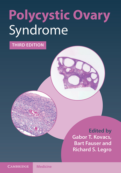 Polycystic Ovary Syndrome 