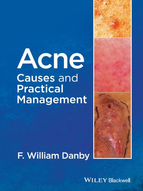 Cover image for book Acne