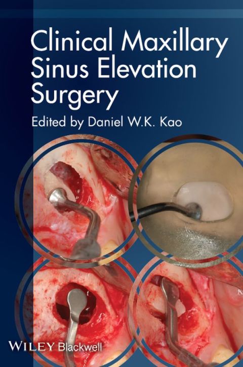 Cover image for book Clinical Maxillary Sinus Elevation Surgery