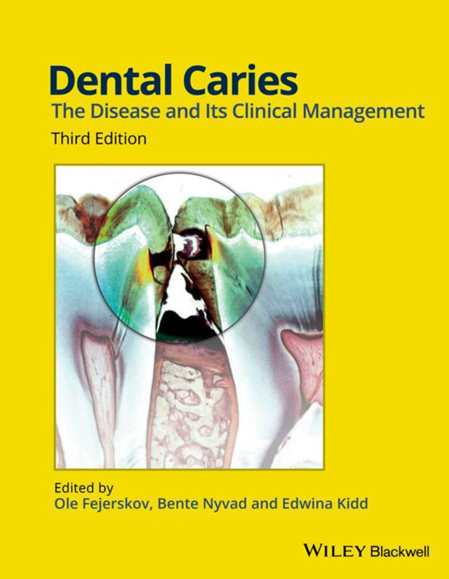 Dental Caries the Disease and Its Clinical Management