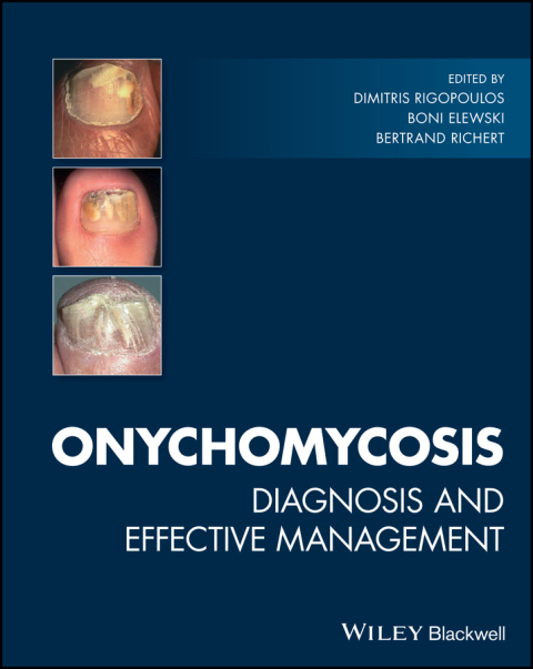 Cover image for book Onychomycosis
