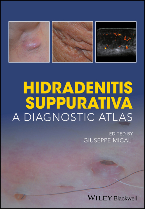 Cover image for book Hidradenitis Suppurativa