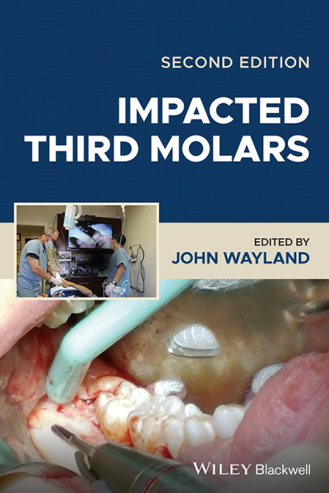 Cover image for book Impacted Third Molars