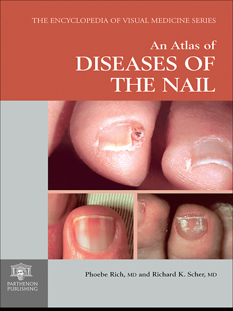 Cover image for book An Atlas of Diseases of the Nail